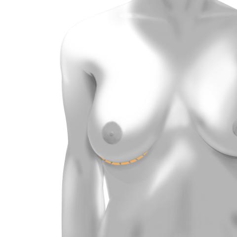 Breast Augmentation Scars: What to Expect