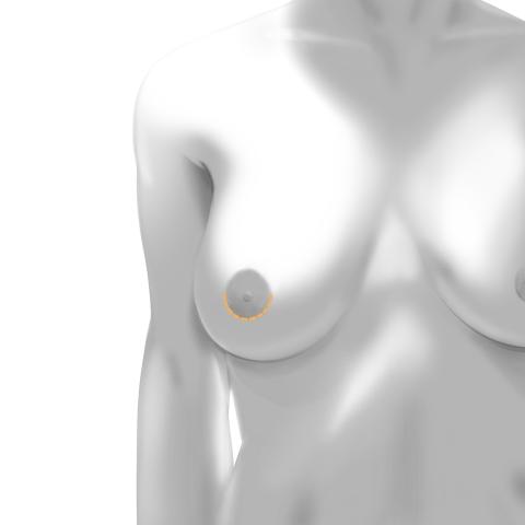 Breast Augmentation Incision Techniques: Areolar vs. Inframammary!