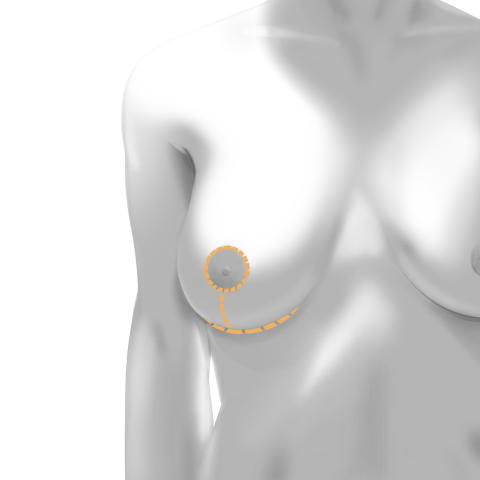 Breast Lift (Mastopexy) Scars & Incisions