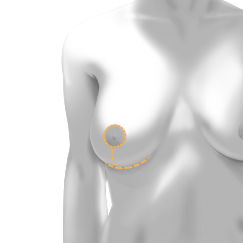 Is a Breast Lift the Best Option After Losing a Significant Amount