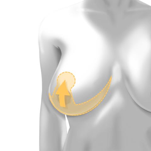 This patient desired an Areola Reduction to improve his