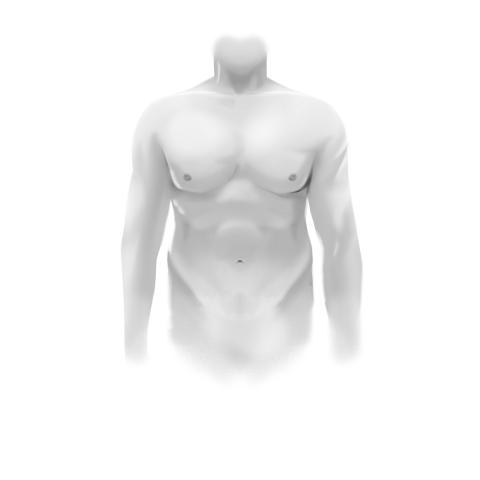 Gynecomastia Surgery After