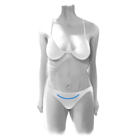 Mini tummy tuck incision