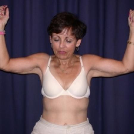 Case #79866 - Bliateral Brachioplasty with Liposuction of Arms