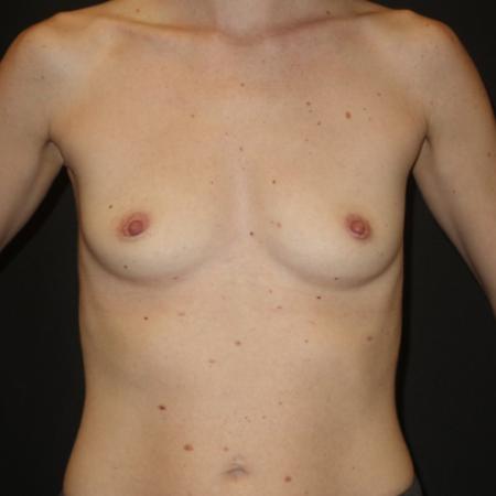 Before image 1 Case #106011 - Breast Augmentation