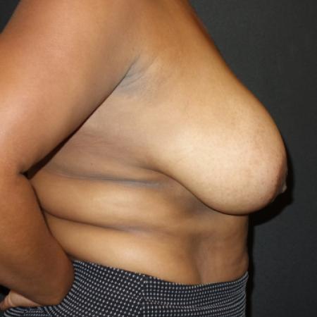 Before image 3 Case #106096 - Breast Reduction