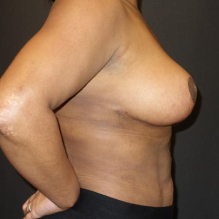 After image 3 Case #106096 - Breast Reduction