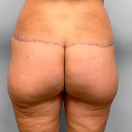 Butt Augmentation Overview: Cost, Recovery, Before & After