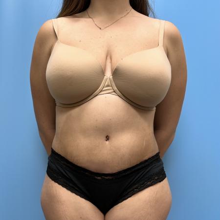 After image 1 Case #111601 - Tummy Tuck with Lipo 360 3