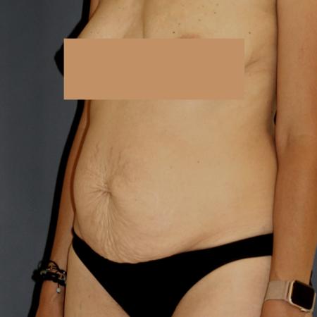 Before image 2 Case #111586 - Tummy Tuck (Abdominoplasty)