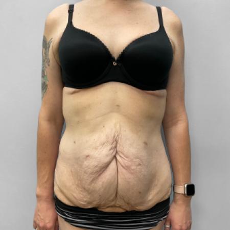 Before image 1 Case #111396 - Abdominoplasty & Liposuction