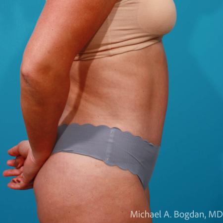 After image 3 Case #111766 - Abdominoplasty