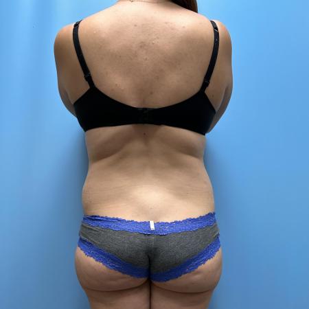 Before image 4 Case #111601 - Tummy Tuck with Lipo 360 3