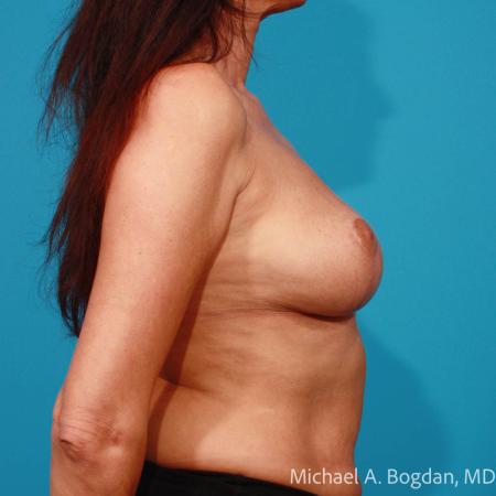 Before image 3 Case #111651 - Breast Augmentation