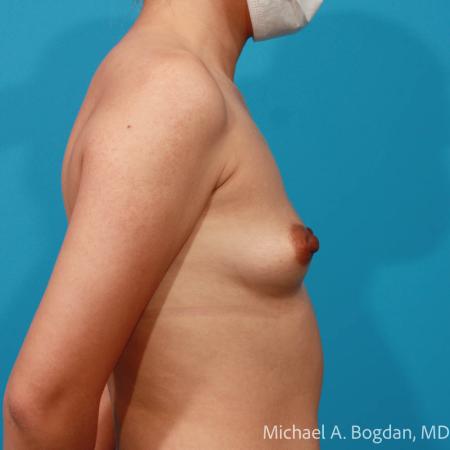 Before image 3 Case #111786 - Breast Augmentation