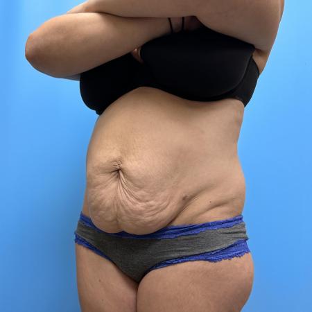 Before image 2 Case #111601 - Tummy Tuck with Lipo 360 3