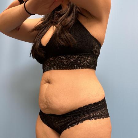 Before image 2 Case #111461 - Tummy Tuck with Lipo 360