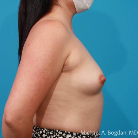 Before image 3 Case #111761 - Breast Augmentation
