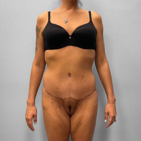After image 1 Case #111396 - Abdominoplasty & Liposuction