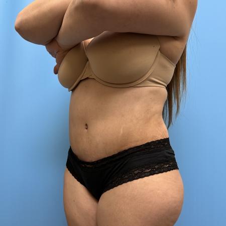 After image 2 Case #111601 - Tummy Tuck with Lipo 360 3