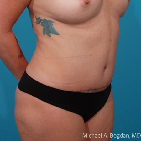 After image 2 Case #111756 - Abdominoplasty