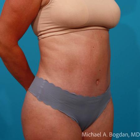 After image 2 Case #111766 - Abdominoplasty