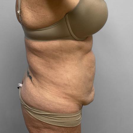 Before Case #111386 - Abdominoplasty with Liposuction