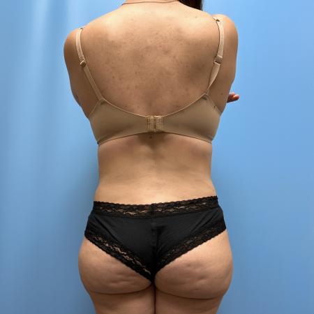 After image 4 Case #111601 - Tummy Tuck with Lipo 360 3