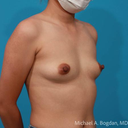 Before image 2 Case #111786 - Breast Augmentation