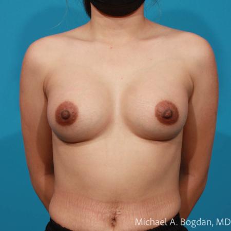 After image 1 Case #111786 - Breast Augmentation