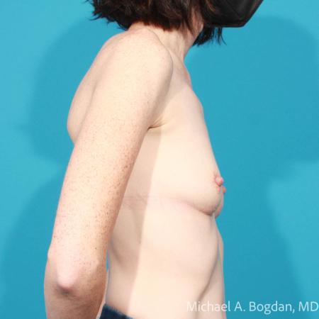 Before image 3 Case #111746 - Breast Augmentation