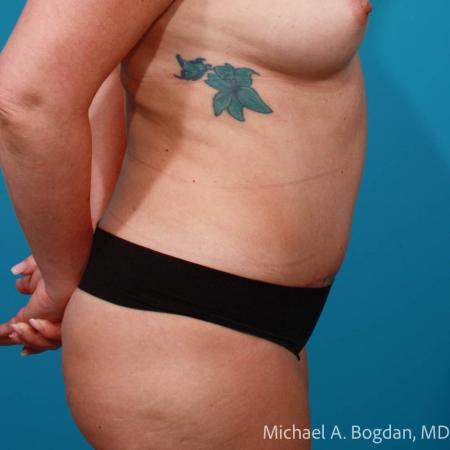 After image 3 Case #111756 - Abdominoplasty