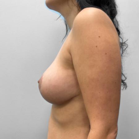 After Case #111391 - Breast Lift 