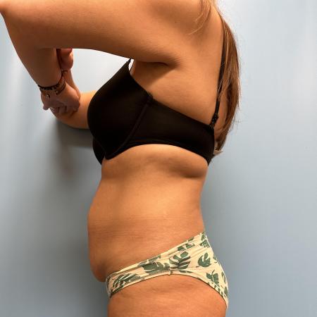 Before image 3 Case #111466 - Tummy Tuck with Lipo 360 2