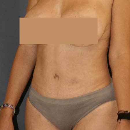 After image 2 Case #111586 - Tummy Tuck (Abdominoplasty)