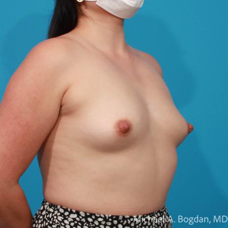 Before image 2 Case #111761 - Breast Augmentation