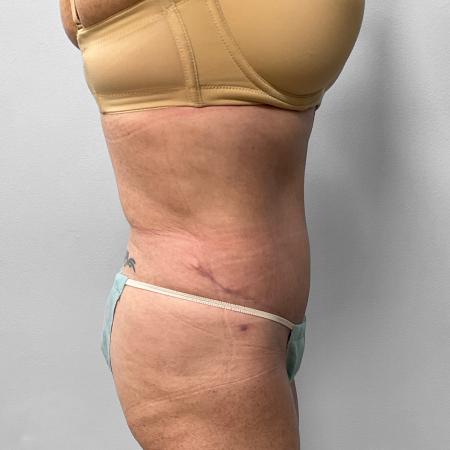 After Case #111386 - Abdominoplasty with Liposuction