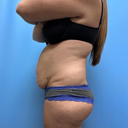 Before image 3 Case #111601 - Tummy Tuck with Lipo 360 3
