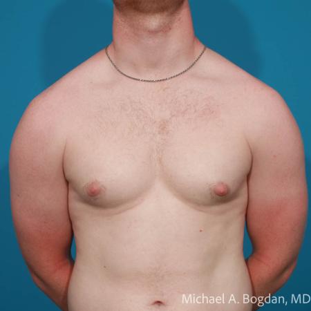 Gynecomastia Plastic Surgery Photos The Aesthetic Society