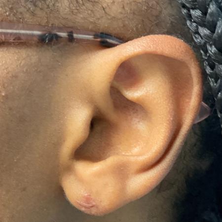 After image 1 Case #112396 - Earlobe repair