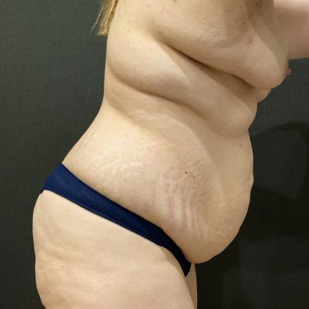 Before image 2 Case #114191 - Abdominoplasty with Liposuction of Chest & Flanks
