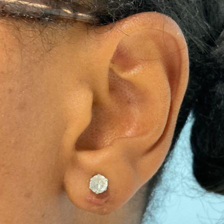 After image 2 Case #112396 - Earlobe repair