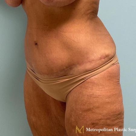 After image 2 Case #112281 - Abdominoplasty