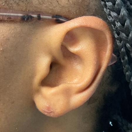 Before image 2 Case #112396 - Earlobe repair