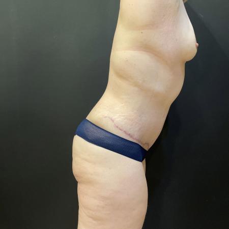 After image 2 Case #114191 - Abdominoplasty with Liposuction of Chest & Flanks