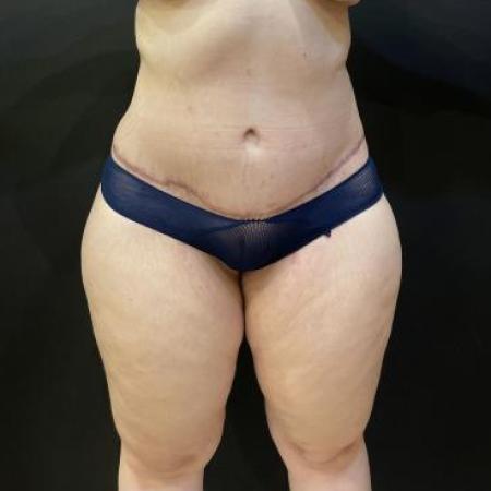 After image 1 Case #114191 - Abdominoplasty with Liposuction of Chest & Flanks