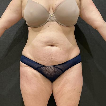 Before image 1 Case #114466 - Abdominoplasty with Liposuction and Fat Transfer