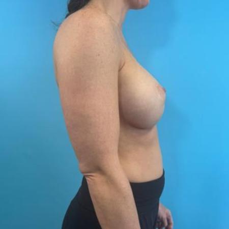 After image 5 Case #114681 - Breast Implants plus a little extra...