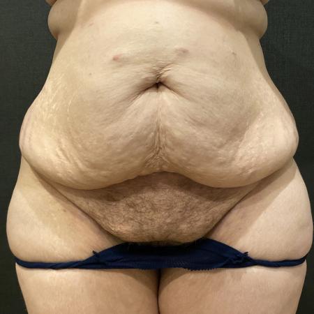 Before image 1 Case #114191 - Abdominoplasty with Liposuction of Chest & Flanks