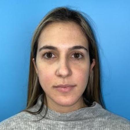 Before image 3 Case #114356 - Smiling 6 months after Rhinoplasty